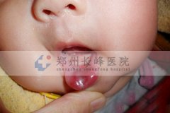 郑州长峰医院——刚出生的宝宝身上的血管瘤会自己消退是不是真的？